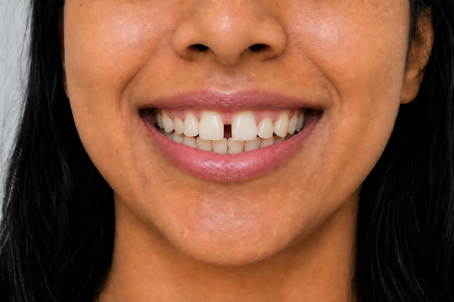 Smile before Clearbee alignment